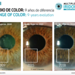 Escurecimento da cor da íris como resultado de um colírio para o glaucoma