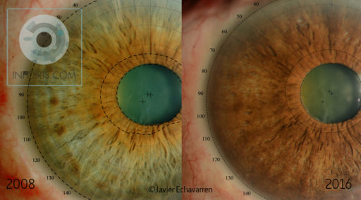 Radical change of iris colour