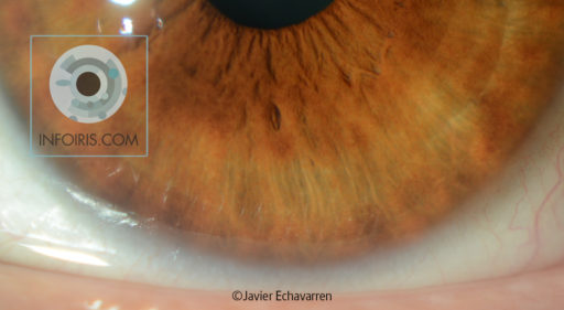 Oesophageal Rupture. Boerhaave Syndrome.