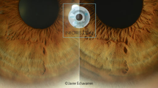Importance of the angle of light when observing the iris