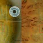 Iridian sign: New Stain in left iris.