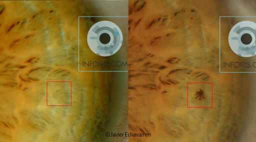 Iridian sign: New Stain in left iris.