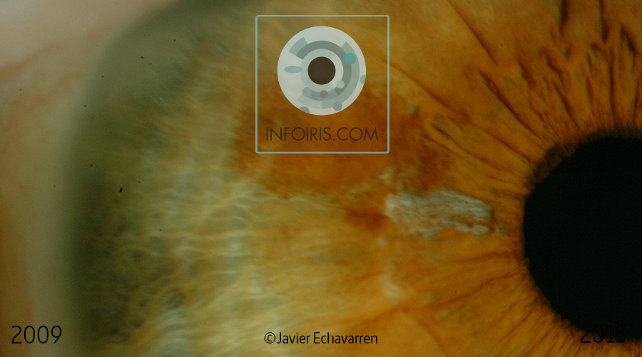 Case no. 6.  Abrasion of the iris tissue. Loss of pigmentation