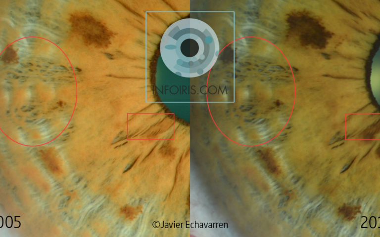 Un autre exemple de l&rsquo;évolution des signes de l&rsquo;iris