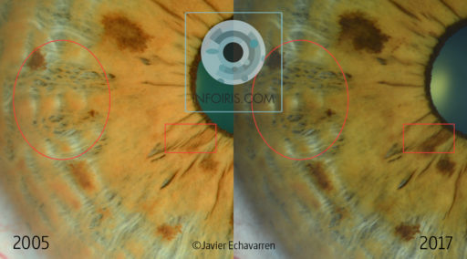 Another example of the evolution of iris signs
