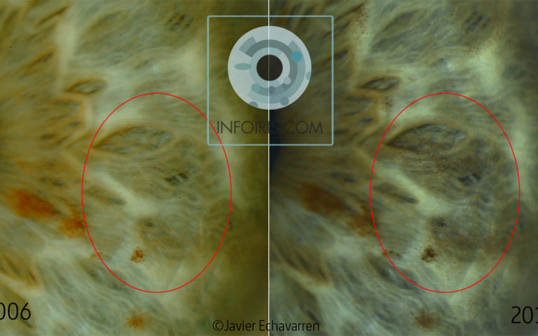Formation de Micropigmentation à le Zone Topographique du poumon gauche.