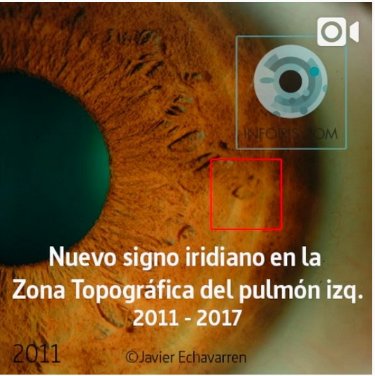 Video corto (1) nueva mancha en Zona Topográfica del pulmón izquierdo.